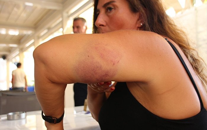 Bodrum’da iki kişi caretta caretta saldırısına uğradı