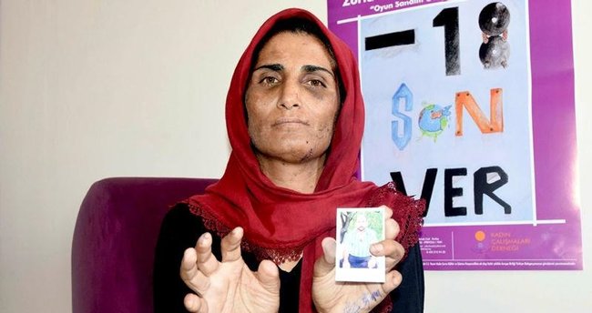 İşkenceci kocası yüzünden 11 parmağını yitirdi