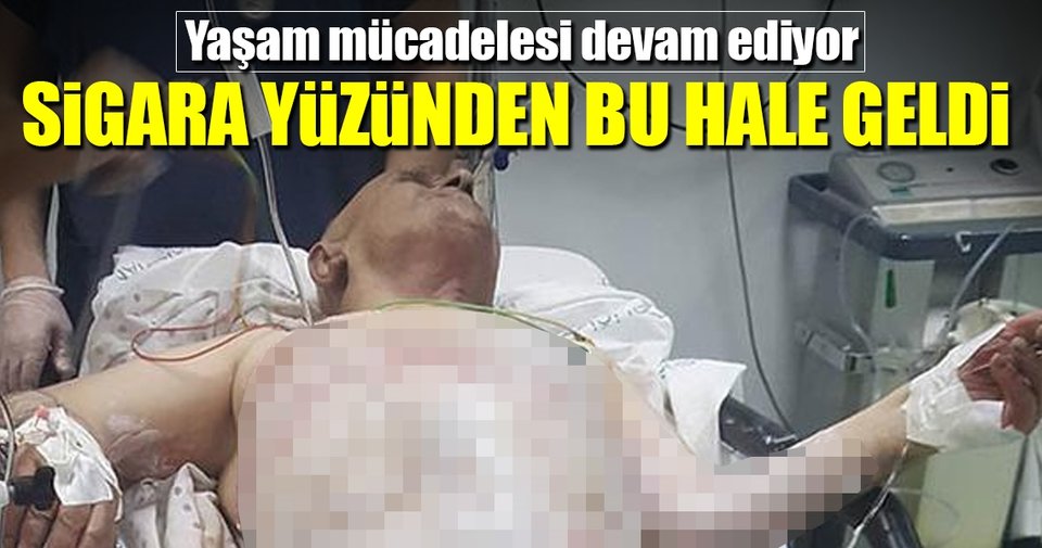 Sigara yüzünden bu hale geldi