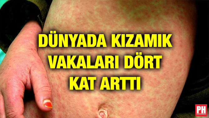 DÜNYADA KIZAMIK VAKALARI DÖRT KAT ARTTI
