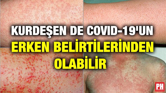 KURDEŞEN DE COVID-19’UN ERKEN BELİRTİLERİNDEN OLABİLİR
