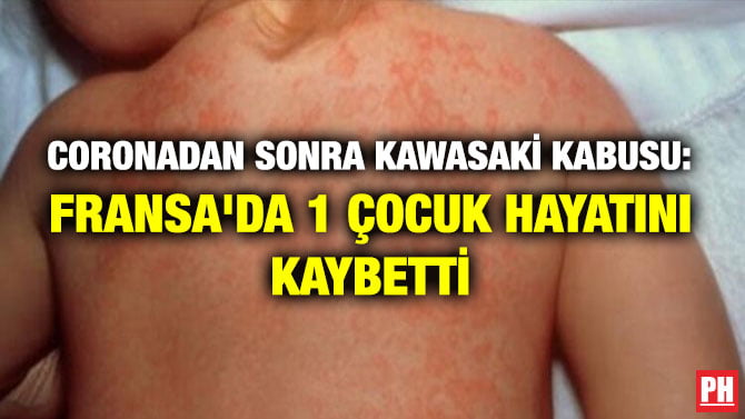 CORONADAN SONRA KAWASAKİ KABUSU: FRANSA’DA 1 ÇOCUK HAYATINI KAYBETTİ