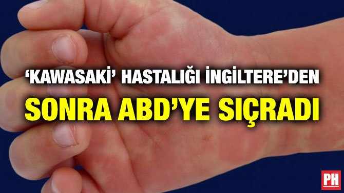 ‘KAWASAKİ’ HASTALIĞI İNGİLTERE’DEN SONRA ABD’YE SIÇRADI