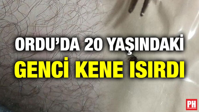 ORDU’DA 20 YAŞINDAKİ GENCİ KENE ISIRDI