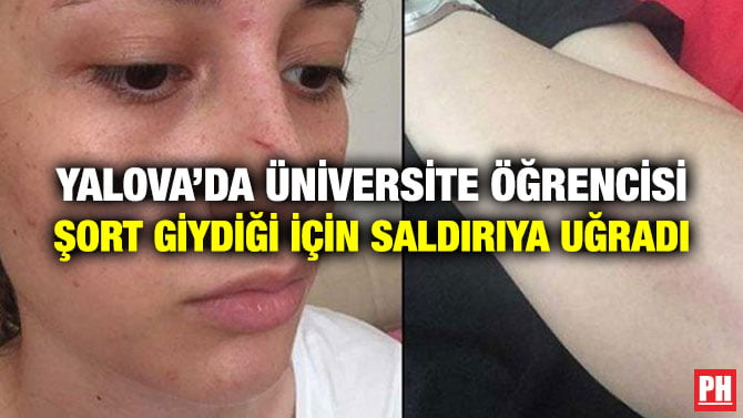 YALOVA’DA ÜNİVERSİTE ÖĞRENCİSİ ŞORT GİYDİĞİ İÇİN SALDIRIYA UĞRADI