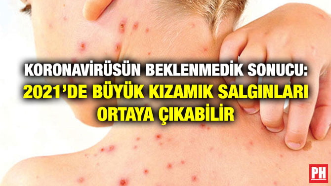 KORONAVİRÜSÜN BEKLENMEDİK SONUCU: 2021’DE BÜYÜK KIZAMIK SALGINLARI ORTAYA ÇIKABİLİR