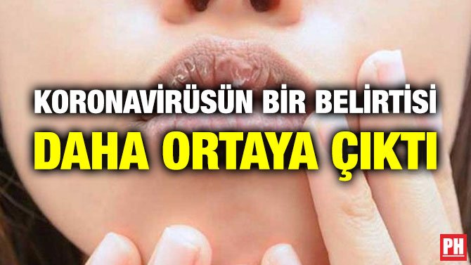 KORONAVİRÜSÜN BİR BELİRTİSİ DAHA ORTAYA ÇIKTI