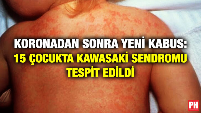 Koronadan Sonra Yeni Kabus: 15 Çocukta Kawasaki Sendromu Tespit Edildi