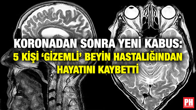 Koronadan Sonra Yeni Kabus: 5 Kişi ‘Gizemli’ Beyin Hastalığından Hayatını Kaybetti