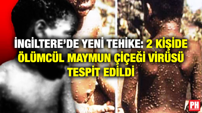 İngiltere’de Yeni Tehike: 2 Kişide Ölümcül Maymun Çiçeği Virüsü Tespit Edildi