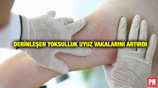 Derinleşen Yoksulluk Uyuz Vakalarını Artırdı