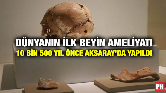 Dünyanın İlk Beyin Ameliyatı 10 Bin 500 Yıl Önce Aksaray’da Yapıldı