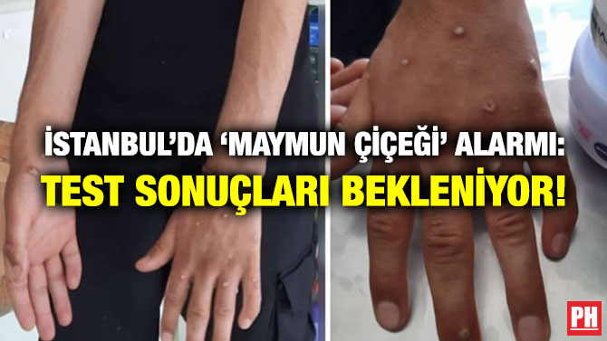 İstanbul’da ‘Maymun Çiçeği’ Alarmı: Test Sonuçları Bekleniyor!