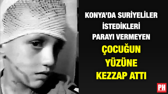 Konya’da Suriyeliler, İstedikleri Parayı Vermeyen Çocuğun Yüzüne Kezzap Attı